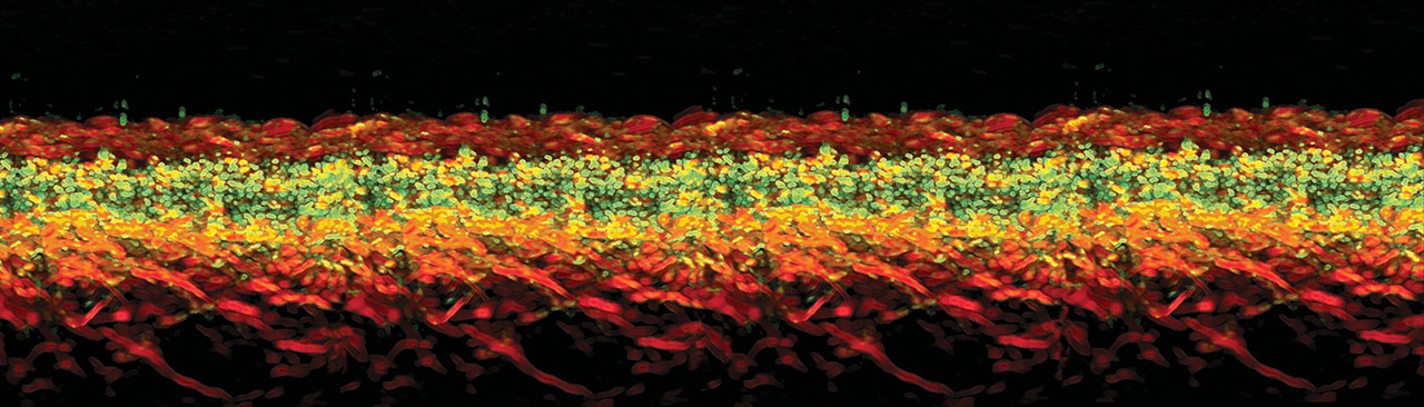 Ultra-broadband photoacoustic imaging of label-free psoriasis biomarkers